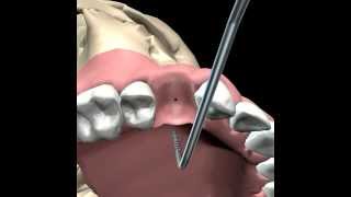 Dental Implants in Costa Rica  Nova Dental Clinic [upl. by Haines]