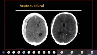 Interpretation approach Trauma and intracranial haemorrhage [upl. by Liagibba]