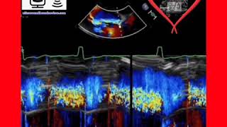 Severe Aortic Regurgitation [upl. by Gates106]