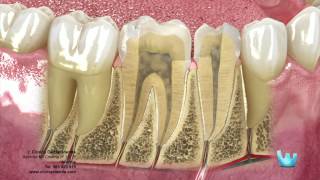 Endodoncia desvitalizar el nervio dental [upl. by Dorraj]