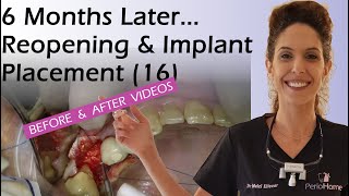 6 Months After Extraction Reopening and Implant Placement [upl. by Paucker]