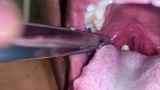 Large Tonsil Stone Removal [upl. by Mallon]