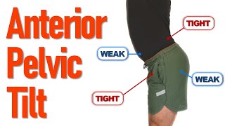 How To Fix Anterior Pelvic Tilt  4 Easy Exercises [upl. by Ellehsal]