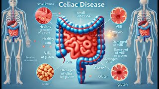 Celiac Disease Gut Health Explained  Modern Medicine [upl. by Eberly]