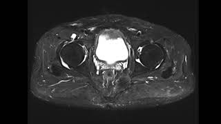 Iliopsoas bursitis [upl. by Ennad]