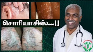 சொரியாசிஸ் என்பது தீரும் நோயா  quotPSORIASISquot SCOPE IN SIDDHA MEDICINE I DrSelvin Siddha I Tamil [upl. by Pietra747]