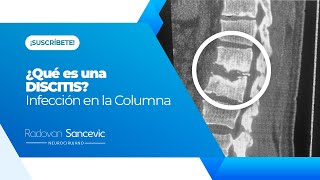 ¿Qué es una DISCITIS INFECCIÓN EN LA COLUMNA VERTEBRAL  Dr Radovan Sancevic [upl. by Krawczyk]