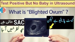 Pregnancy Test Positive But No Baby in Ultrasound  No HeartBeat at 6Weeks  Empty Sac UrduHindi 🌐 [upl. by Hinkel]