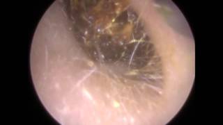 205 Ear Wax Teased and Wriggled out of Narrow Ear Canal  Mr Neel Raithatha THC [upl. by Florence]