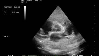 case 459 ECHO pulmonary stenosis PS [upl. by Beare243]