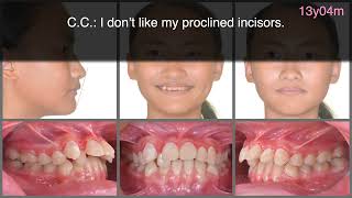 Correction of CML2s amp 10mm Overjet by Clear Aligner｜【Chris Chang Ortho】CC625 [upl. by Loredana]