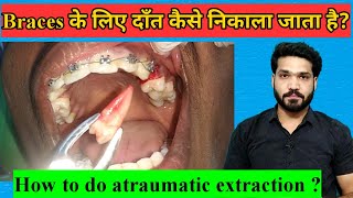 दाँत कैसे निकाला जाता है Extraction for Braces [upl. by Asiela]