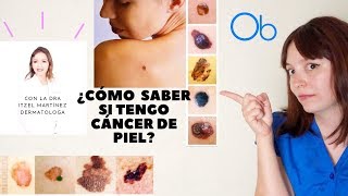 ¿Cómo saber si tengo Cáncer de Piel con la Dra Itzel Mtz 👩🏼‍⚕️Dermatóloga [upl. by Aicia962]