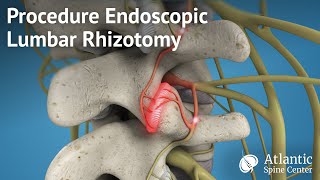 Procedure Endoscopic Lumbar Rhizotomy [upl. by Carson749]