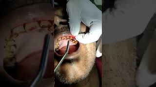 Extraction of a vertically fractured tooth [upl. by Stortz677]