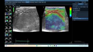 IQ 279 LIVER ULTRASOUND HEPATOMA ECHOPAC ANALYSIS ECHOCARDIOGRAPHY ELASTOGRAPHY 2 [upl. by Zared]