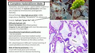 Gestational Trophoblastic Disease Kurts Notes pathagonia [upl. by Negah]