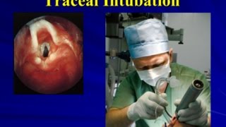 03 Tracheal Intubation [upl. by Luckin]