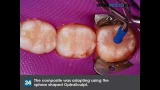 How to Cut Procedure Time in Half with Tetric EvoCeram Bulk Fill [upl. by Arraic]