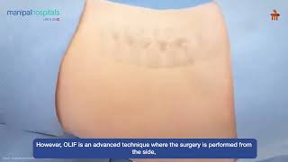 Successful OLIF Surgery  Dr Ashish Dagar  Manipal Hospital Gurugram [upl. by Pelson794]