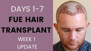 FUE Hair Transplant Week 1  Recovery healing sleeping itching swelling travelling [upl. by Southworth]