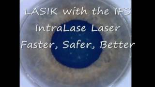 IntraLase LASIK with the iFS [upl. by Brendan]