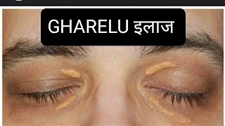 आंखों के पास पीले चकते का घरेलू इलाज  how to self treat XANTHELASMA [upl. by Norwood]