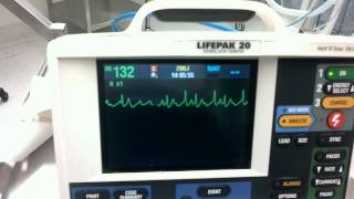 Chemical cardioversion of tachycardia to dx Flutter [upl. by Gupta]