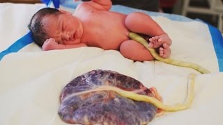 Arizona parents keep placenta attached to baby after birth [upl. by Barolet486]