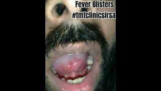 बुखार के साथ मुँह में छालेFever Blisters mouthulcer mouthulcertreatment tmtclinicsirsa [upl. by Ilana140]