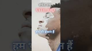 vitiligo awareness shorts vitiligo skincare [upl. by Rebmyk616]