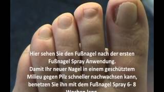 Eingerollte Fußnägel Schnell und einfach bearbeiten Fußnagel Spray [upl. by Immac214]