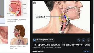 ENT 340 a Larynx Trauma Neck Trachea Injury Hurt LaryngoTracheal Fracture [upl. by Annamarie]