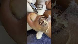 Ingrown Toenail Removal  Toenail Cutting Ep78  Xuyen Camau nailart nail nail2021 nail2023 [upl. by Dru]