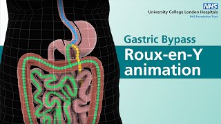 Gastric Bypass  RouxenY animation [upl. by Harahs]