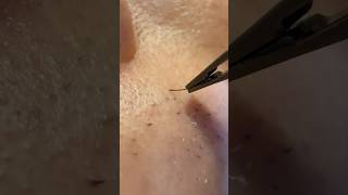 Satisfying Every Time This Addictive Feeling Keeps Me Going hairremoval tweezers ingrownhair [upl. by Aicilf329]