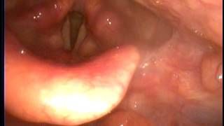 慢性咽喉炎之常見原因 Common Causes of Chronic Pharyngitis [upl. by Asiel]