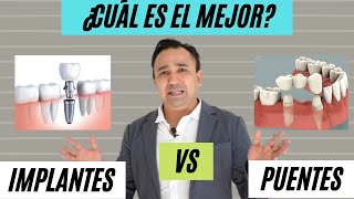 ¿Perdiste un diente  Implantes vs puentes  ¿Cuál es la mejor opción [upl. by Brause]