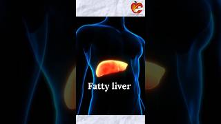 Agar aapko fatty liver hai to ye video jarur dekhiyeby Dt Het Patel fattyliver diet [upl. by Barris924]