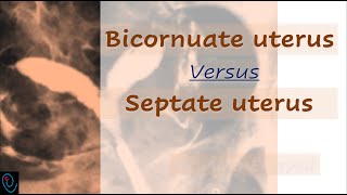 Bicornuate versus Septate uterus [upl. by Bloch111]