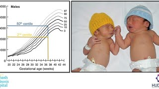 case 535 How to differentiate between SGA symmetrical and Asymmetrical IUGR pondral index [upl. by Chapland]