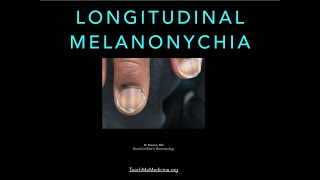 Nails Longitudinal Melanonychia [upl. by Mendie]