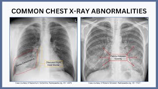 Common Chest X Ray Abnormalities [upl. by Hugon]