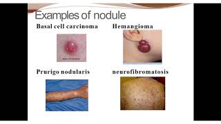 basic terminology used in skin lesion macule papulepustulesnodule vesicle bullae [upl. by Alaine]