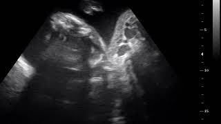 interesting case 467 ultrasound 2D 3D 4D acardiac twin [upl. by Tasiana186]