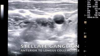 Ultrasound Guided Stellate Ganglion Block [upl. by Cassaundra]