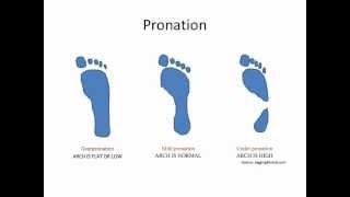 What Is Overpronation [upl. by Norford987]