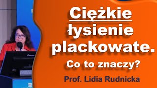 Łysienie plackowate Jak ocenić ciężkość choroby [upl. by Abbotsun]