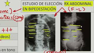 Cirugía general  Obstruccion intestinal ileo post operatorio volvulo instestinal [upl. by Harrietta]