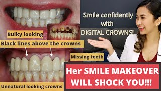 Dental crownfixed bridgeZirconia Crown Procedure and SMILE MAKEOVER [upl. by Colligan998]